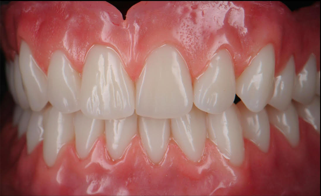 PREMIUM DENTURES WHAT ARE THEY? YYC Denture Clinic